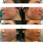 ACNE before and after